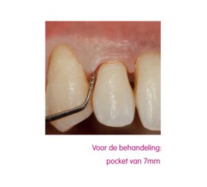 tanden na een behandeling met een pocket