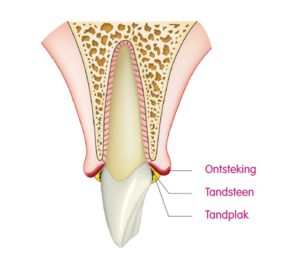 illustratie van tandplak en tandsteen