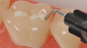 foto van tanden die een sealbehandeling ondergaan